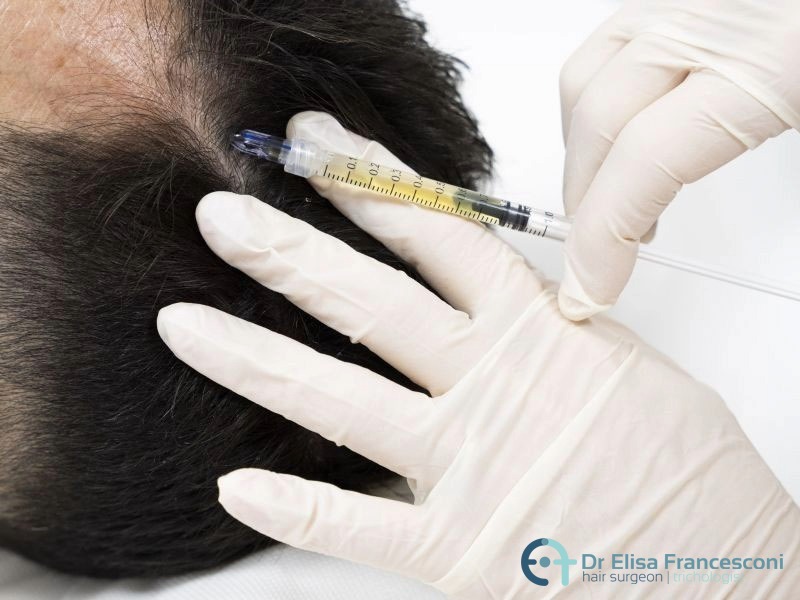 Mesoterapia