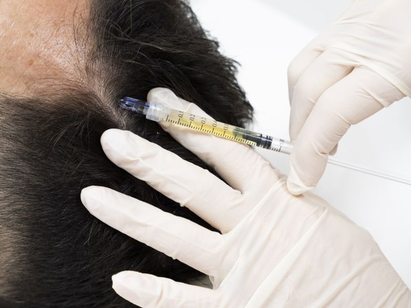Medicina Rigenerativa: S.E.F.F.I. Hair ed Esosomi